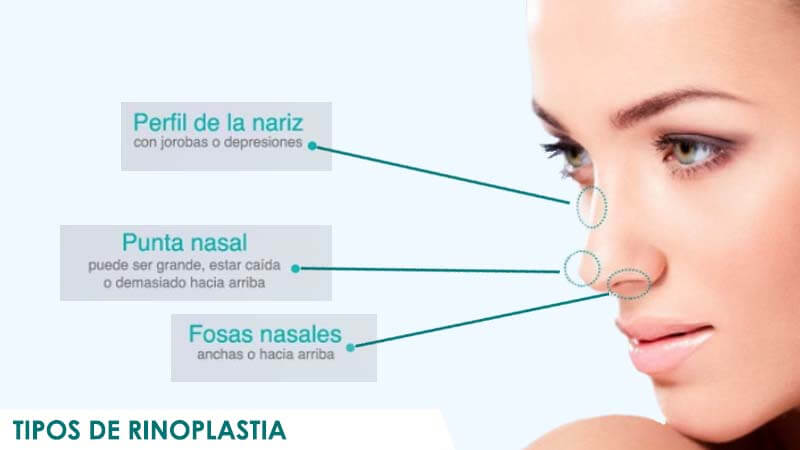 Tipus de rinoplàstia
