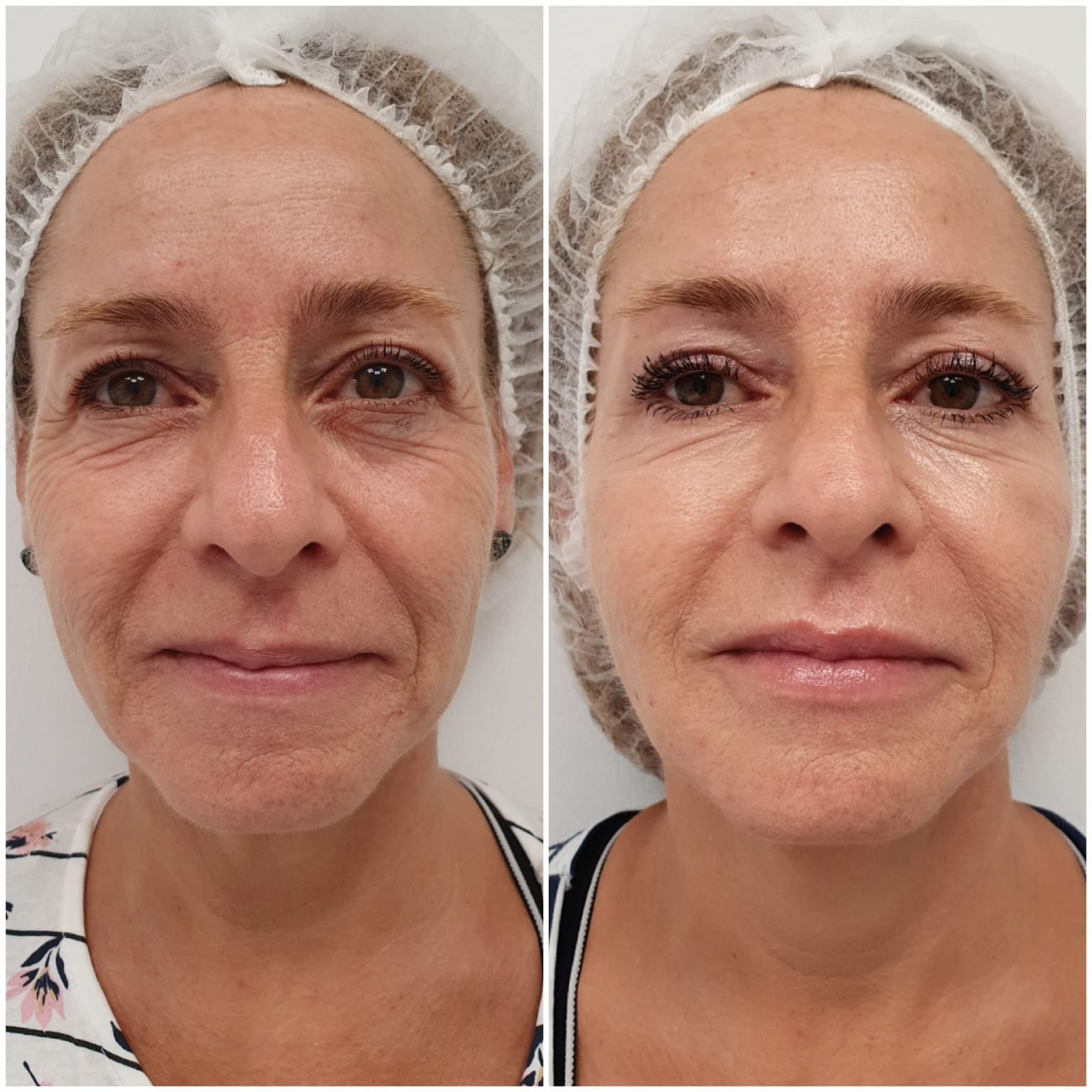 Tractament jove facial