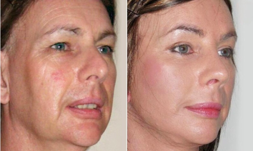 Tractament endolifting Facial